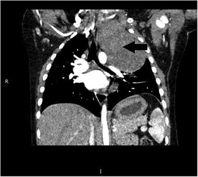 Case Report: A case of thoracoscopic mediastinal tumor resection in a child with ROHHAD syndrome